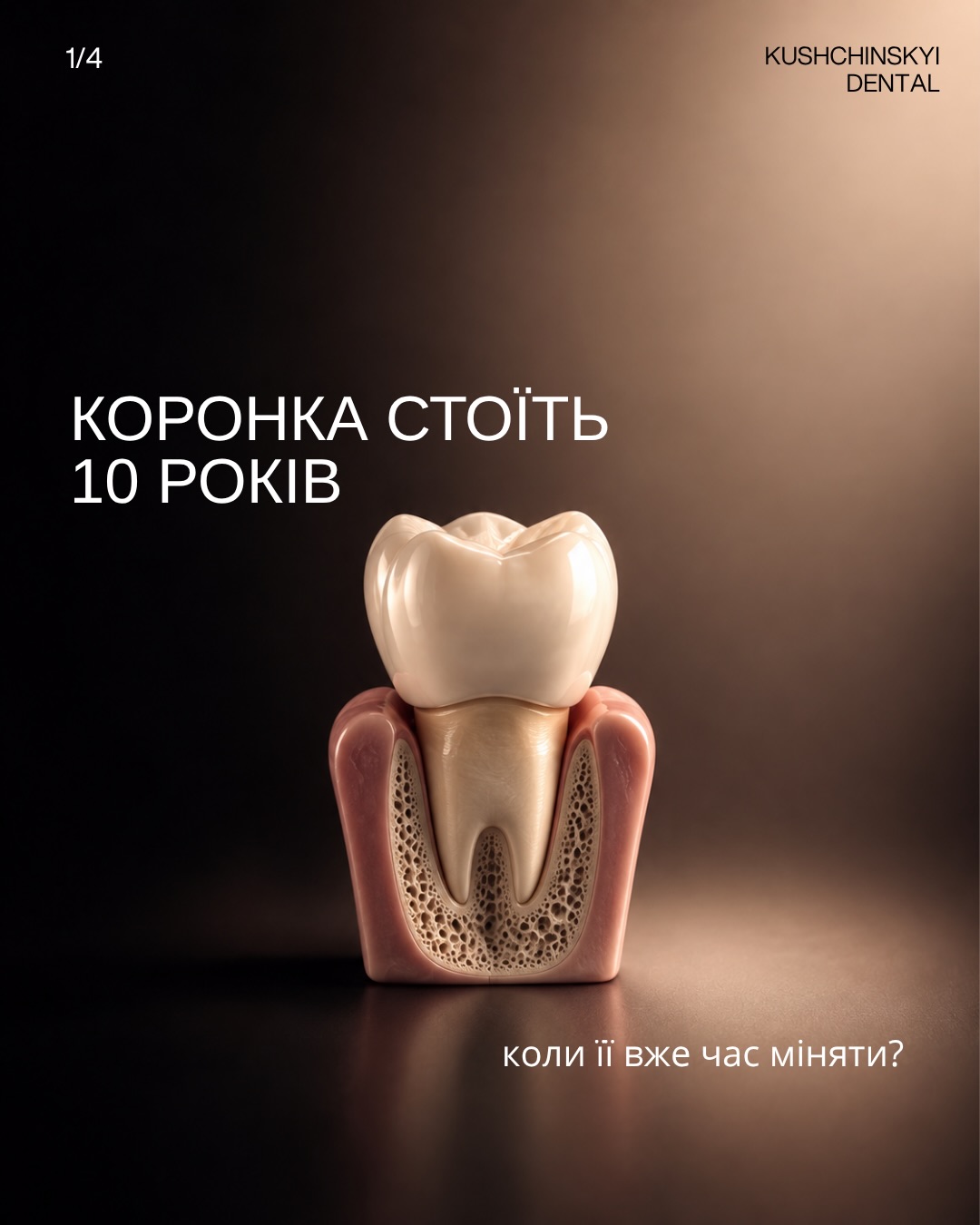 Матеріал клініки про термін служби коронки